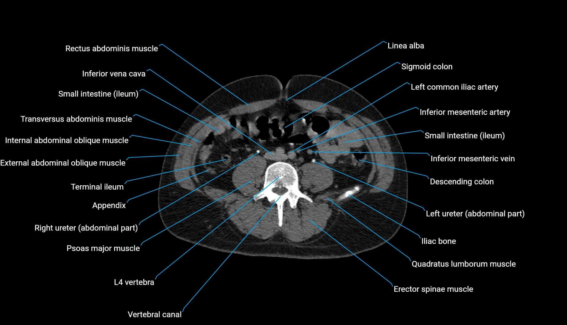 CT urogram axial cross sectional anatomy  labelled radiology image-00152.webp